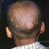 Tinea Capitis