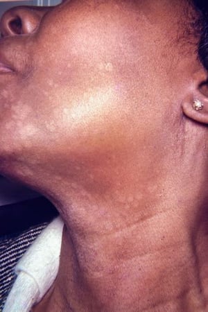 Tinea versicolor con macule ipopigmentate e macchie sulla faccia e sul collo