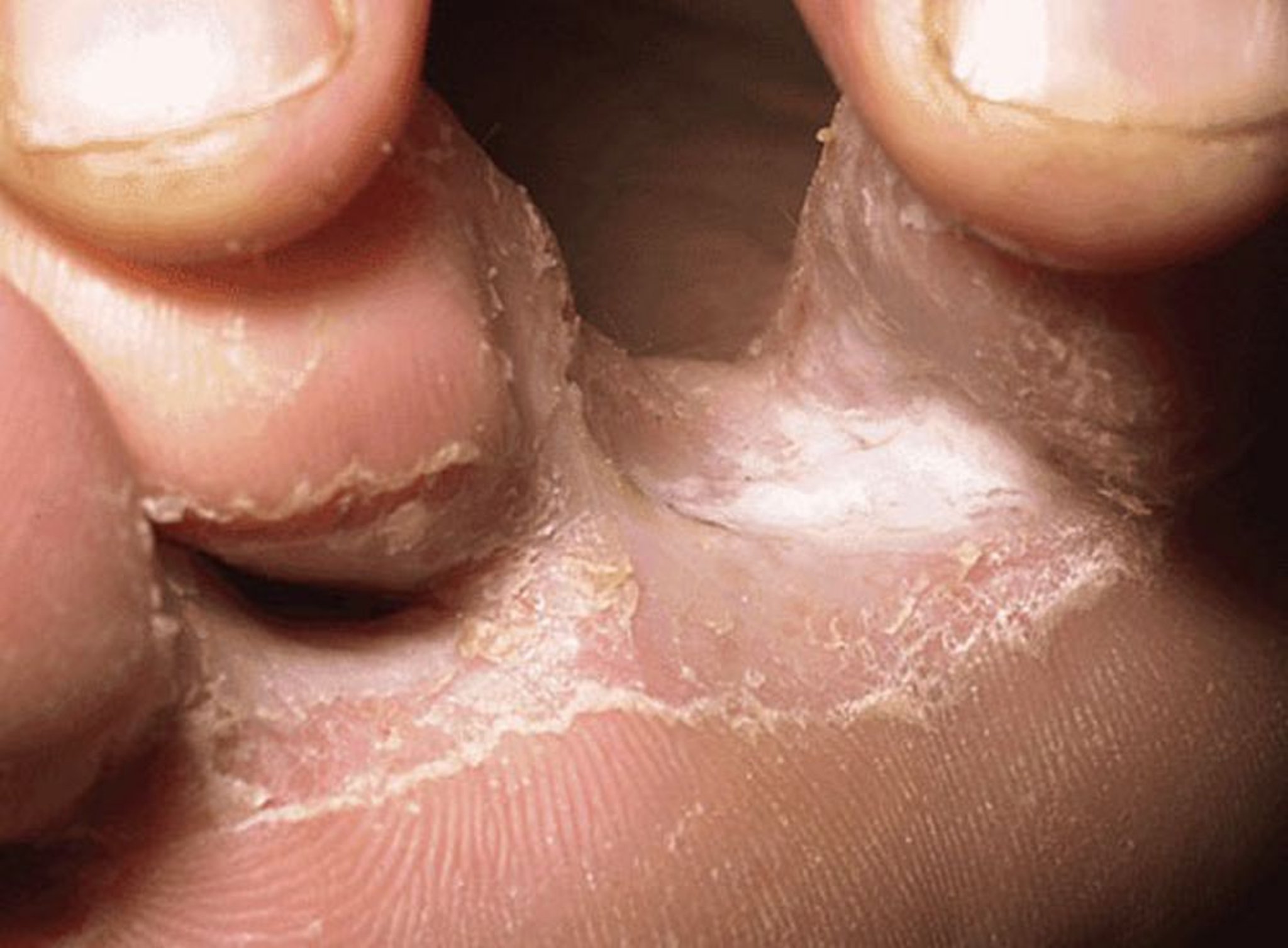 Tiña del pie (tinea pedis) (1)