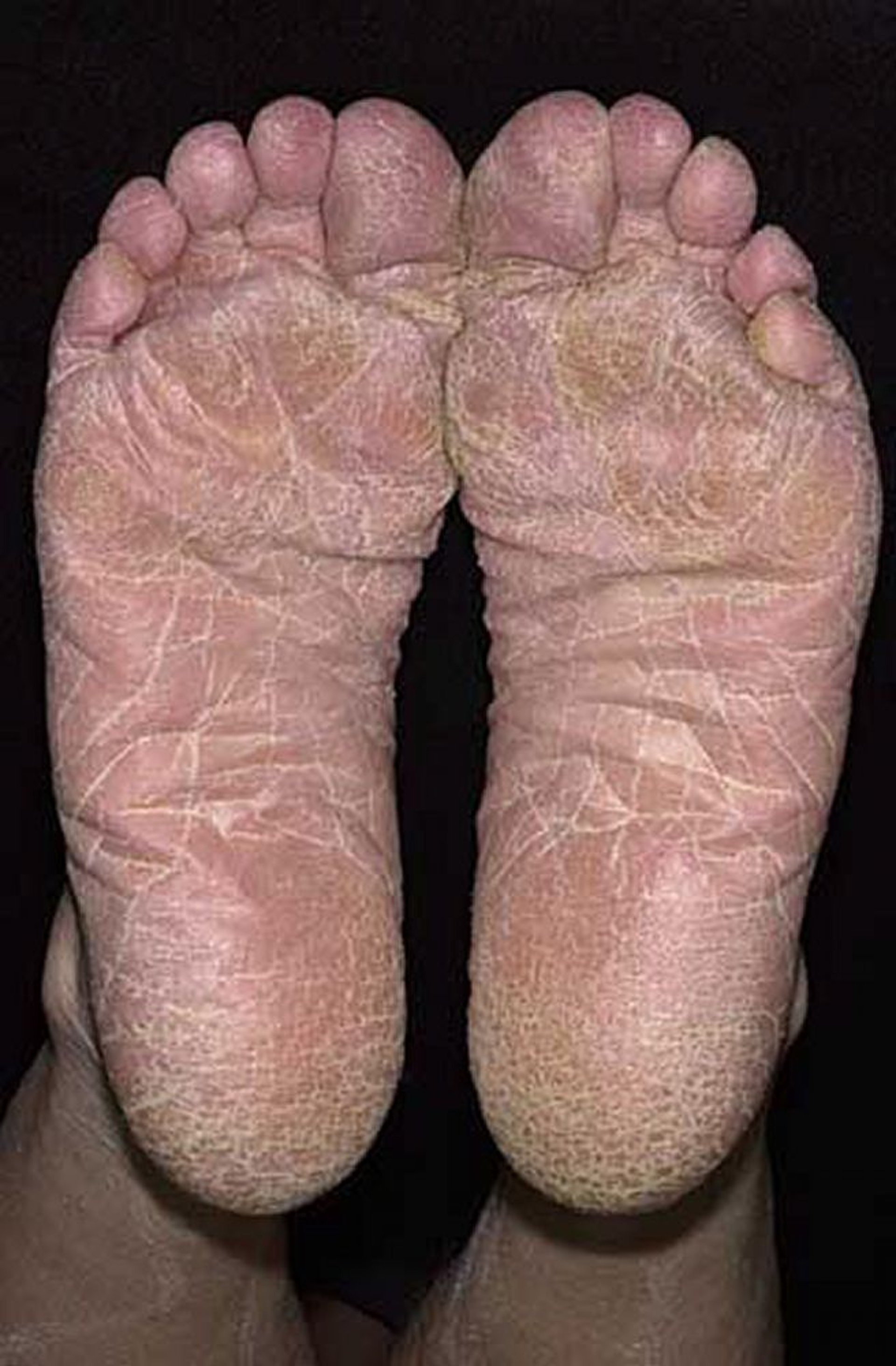 Tinea pedis (distribuzione a mocassino)