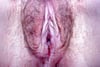 Lichen sclerosus (Labialbefunde)