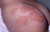 Large-Plaque Parapsoriasis on the Buttocks