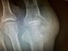 Tophus with Erosion