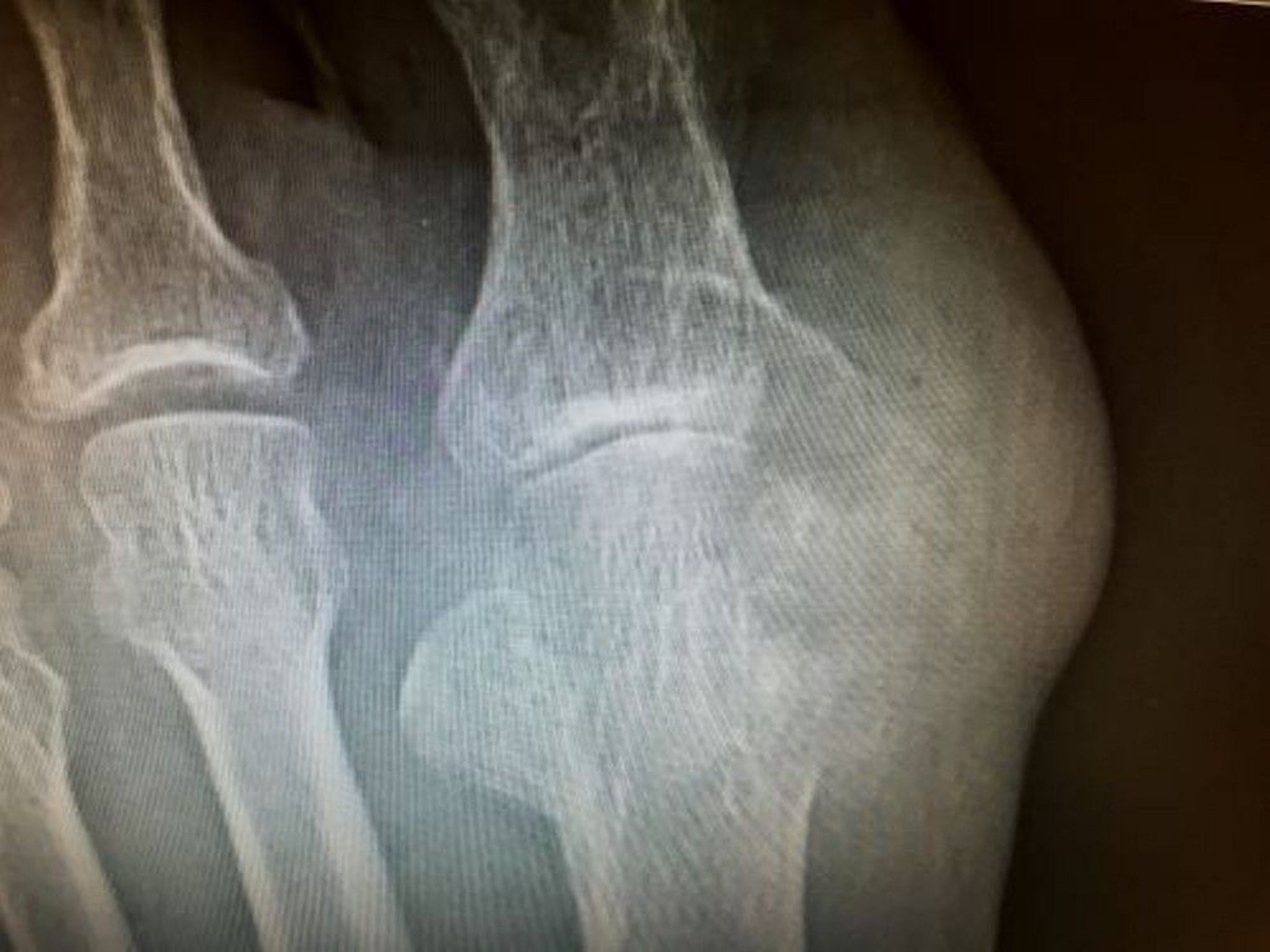 Tophus with Erosion