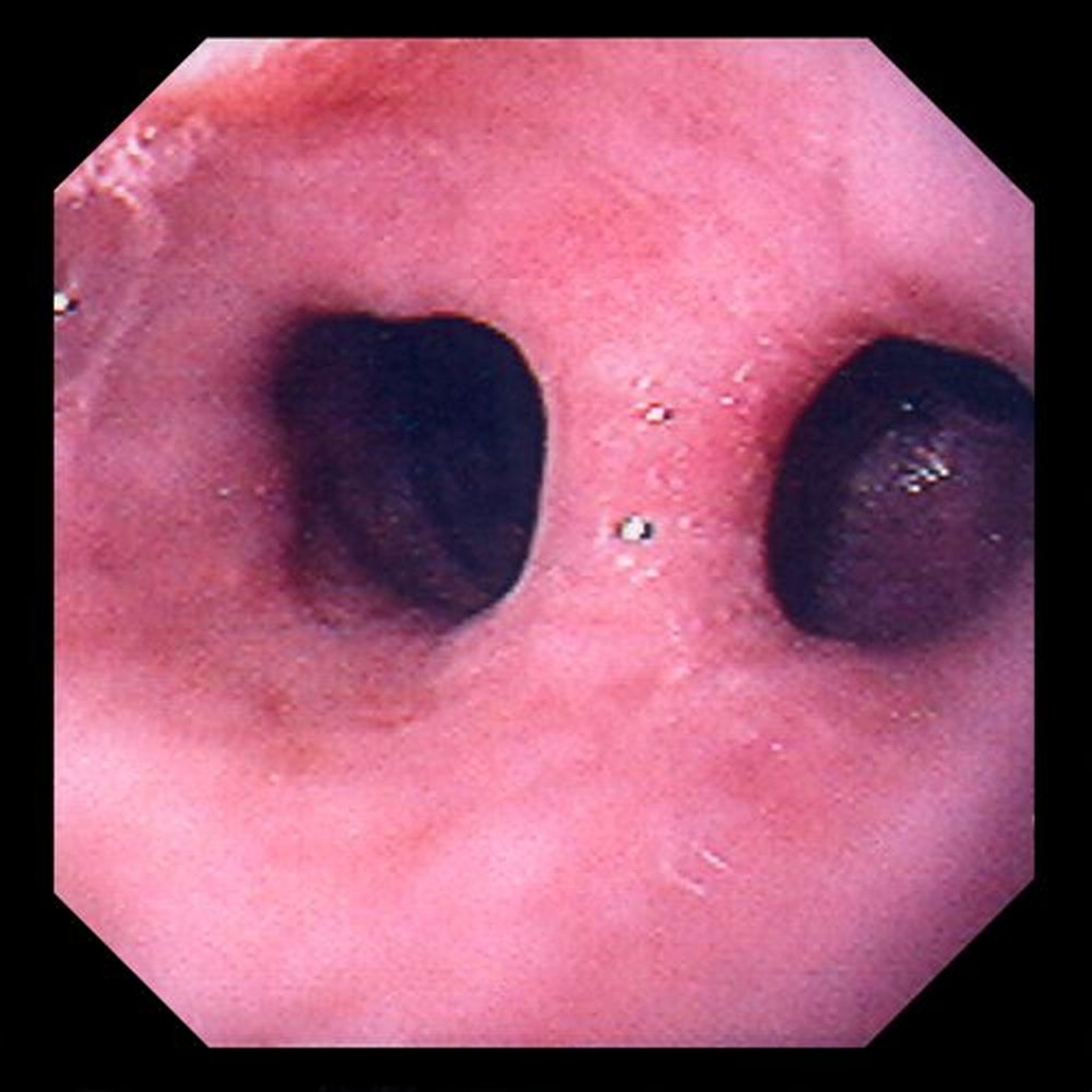Diverticule de traction