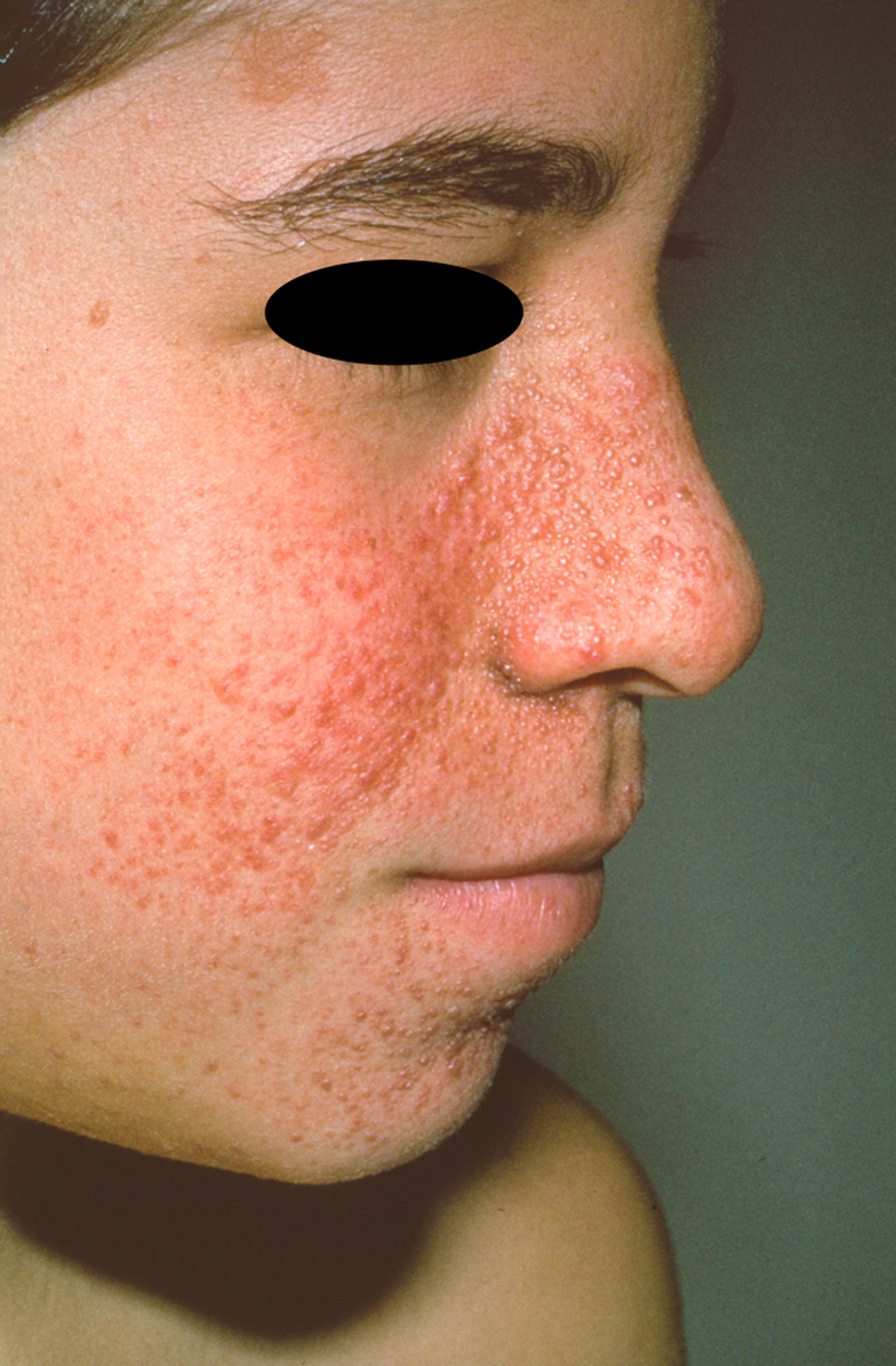 Angiofibromas (Adenoma Sebaceum) in Tuberous Sclerosis Complex (2)