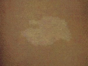 Пятна типа "листьев ясеня"при сложном туберозном склерозе