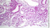 Necrosi tubulare acuta