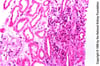 Acute Tubulointerstitial Nephritis