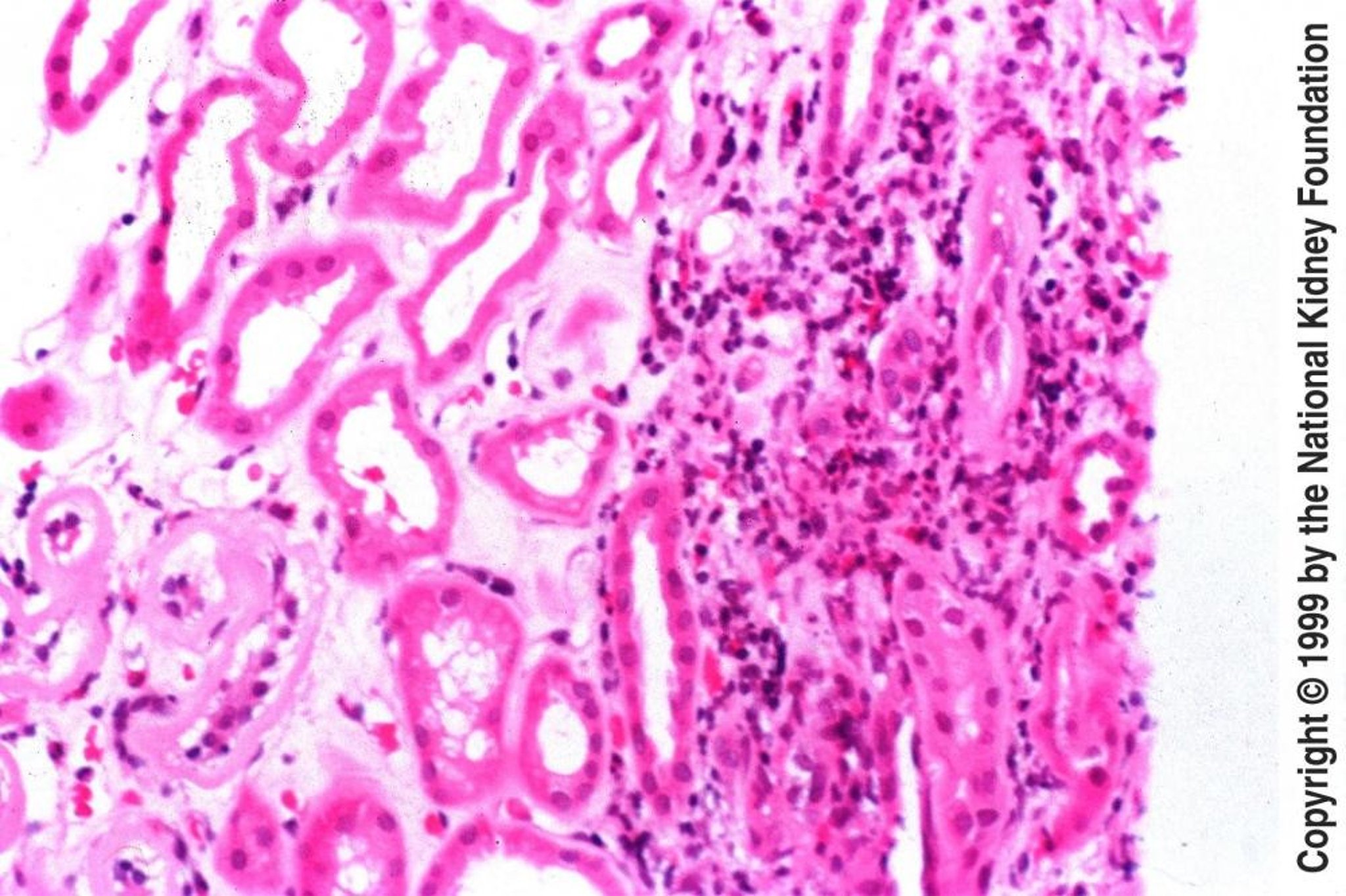 Acute Tubulointerstitial Nephritis