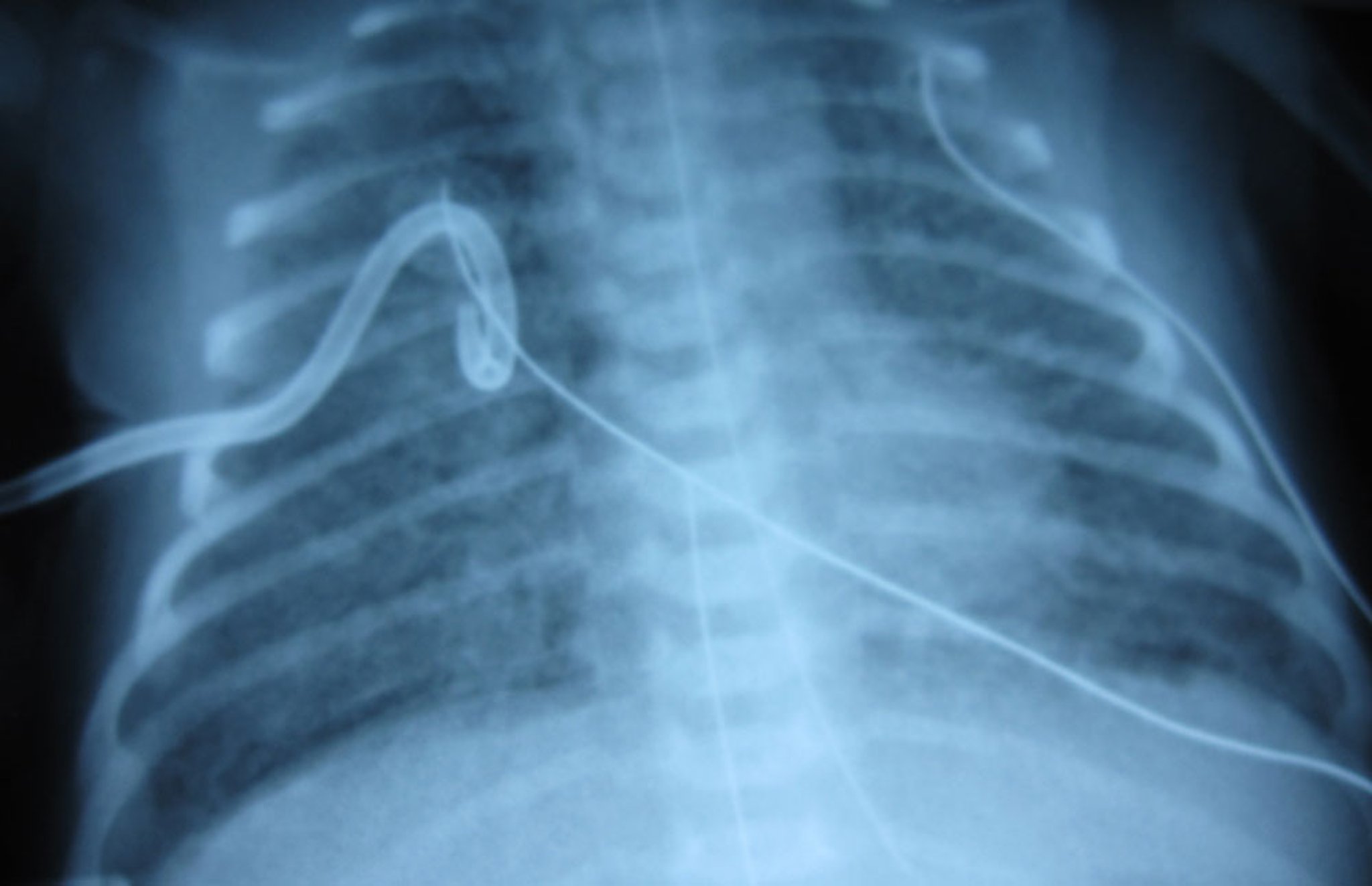 Pneumothorax After Chest Tube Placement