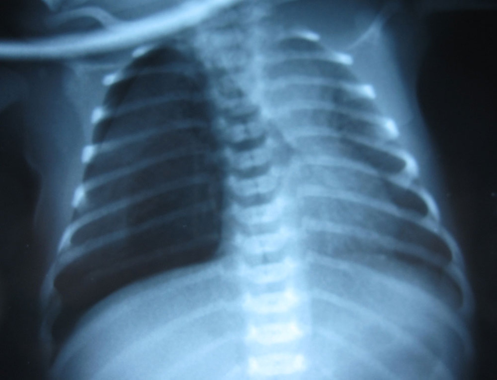 Pneumothorax