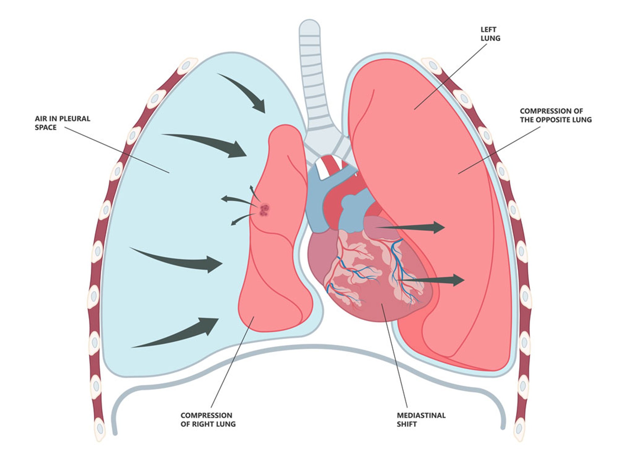 Tension Pneumothorax