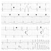 Signos de alarma de taquicardia ventricular polimorfa en entorchado (torsades de pointes)