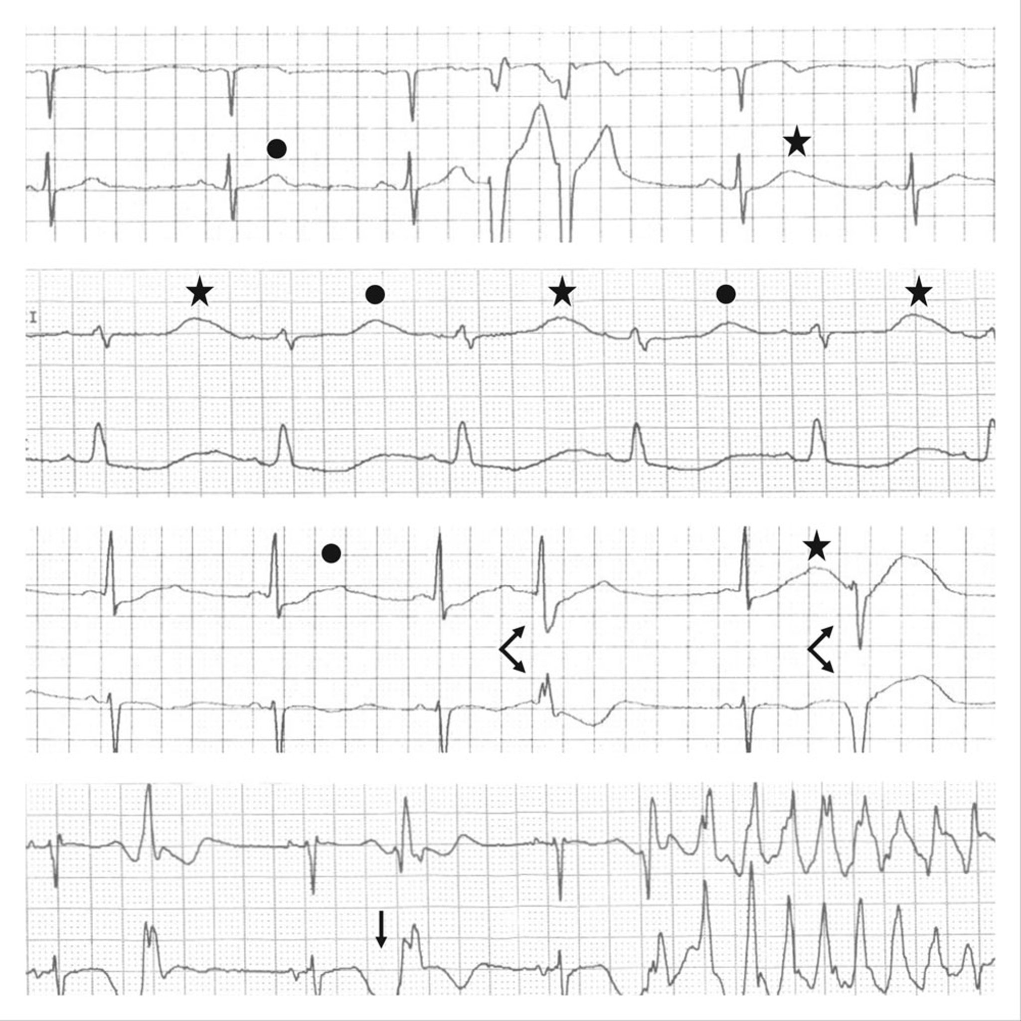 Sinais de alerta da taquicardia ventricular do tipo torsades de pointes