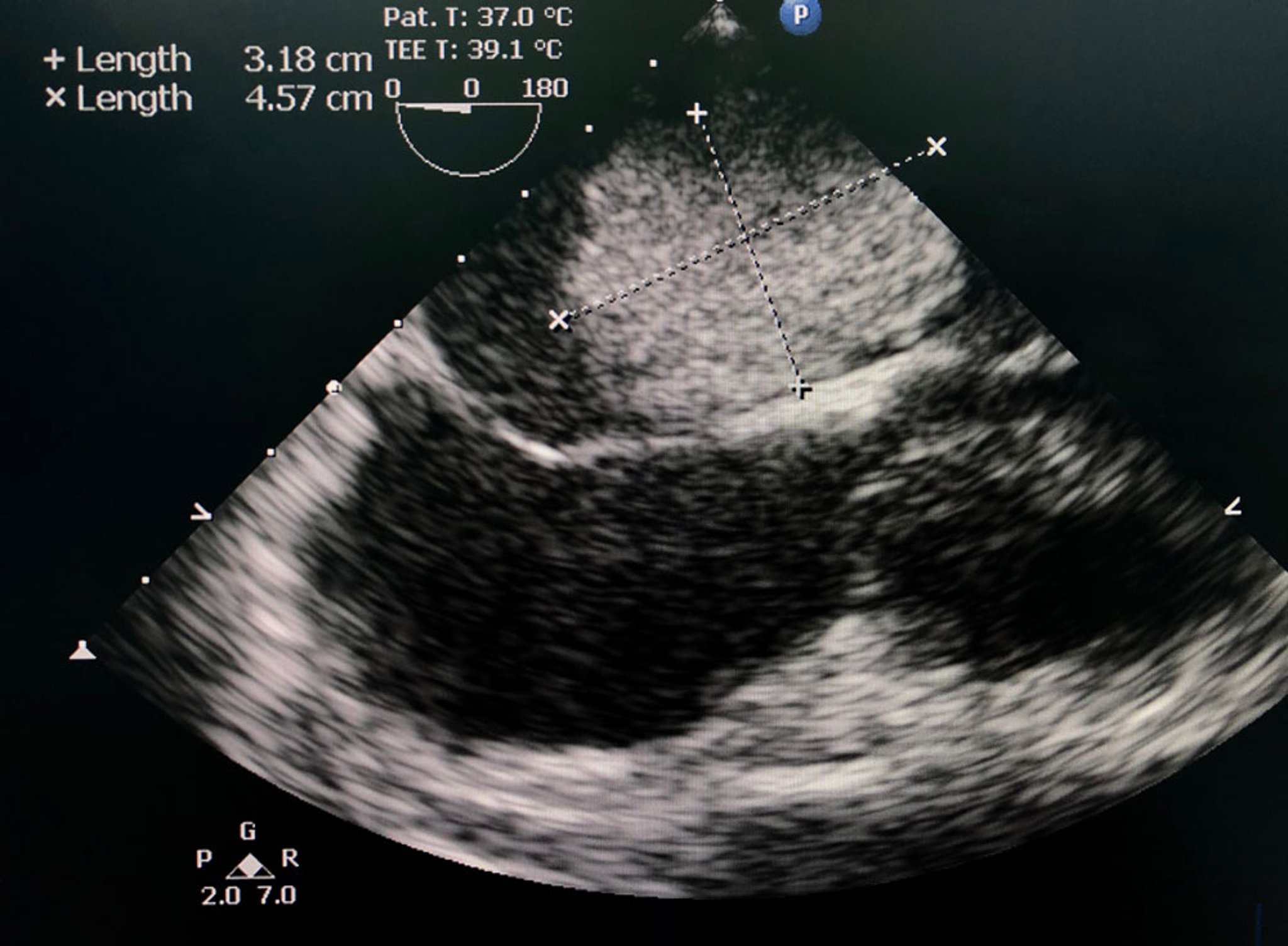 Left Atrial Myxoma (Transesophageal Echocardiogram)