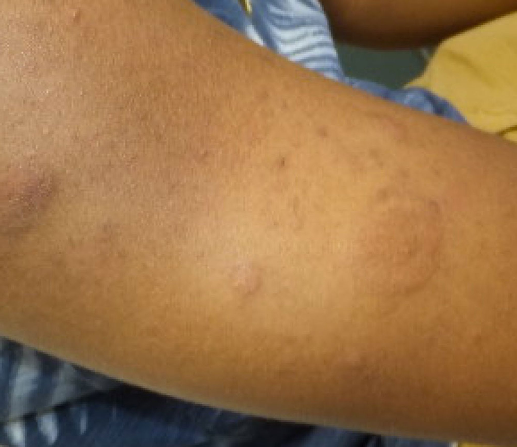 Lúpus eritematoso túmido