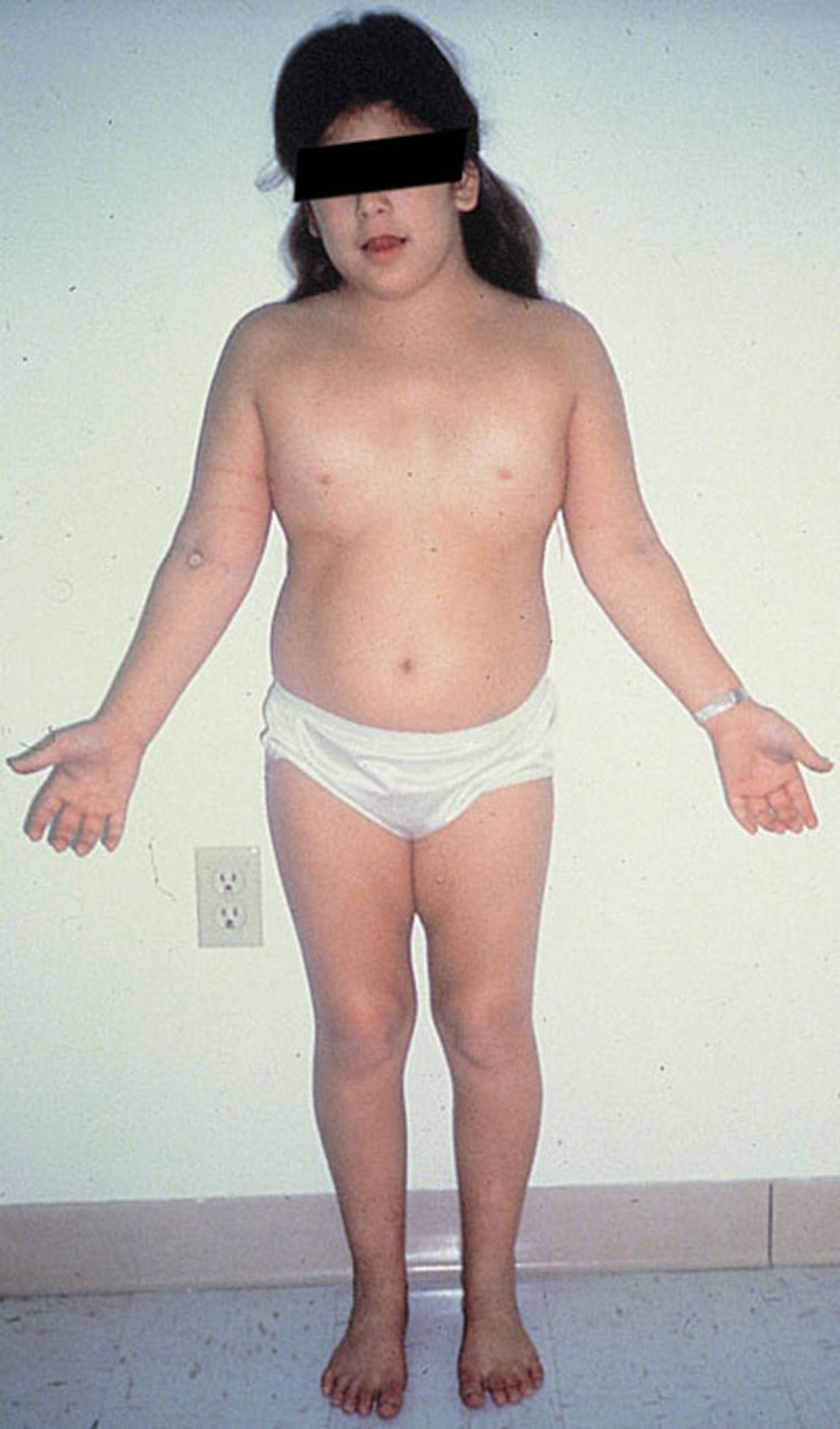 "Shield" Chest in Turner Syndrome