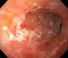 Ulcerative Colitis