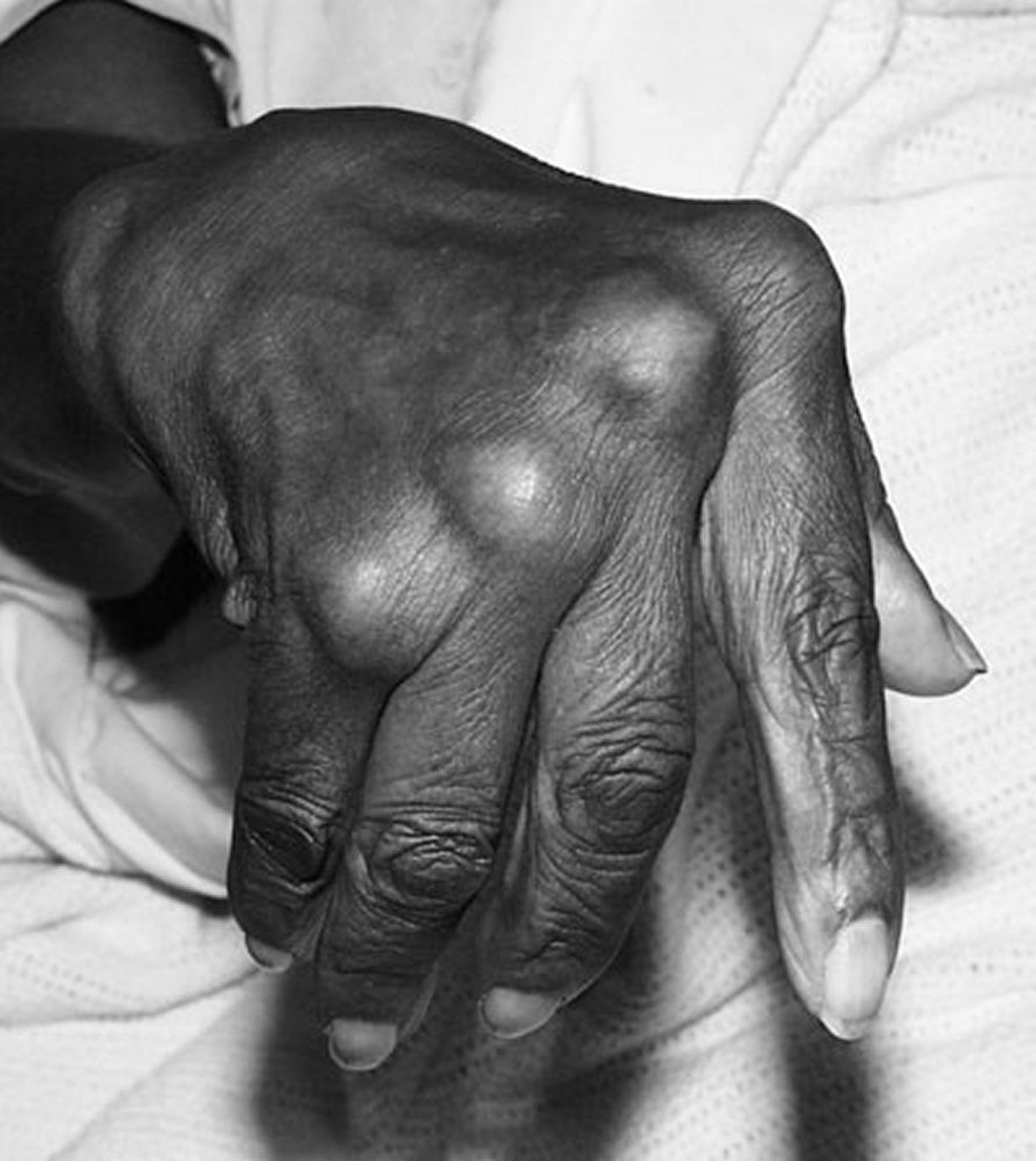 Desvio ulnar