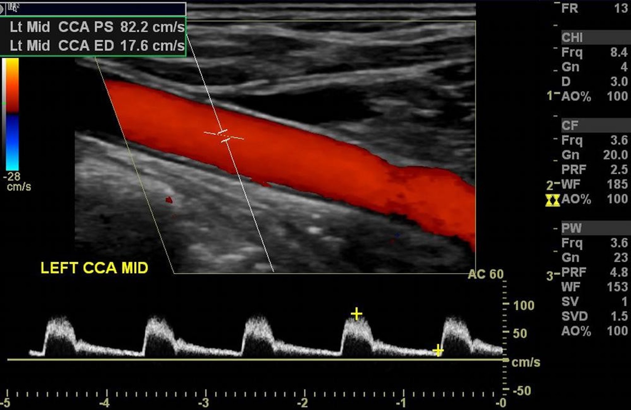 Color Doppler Ultrasonography