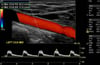 Échodoppler couleur