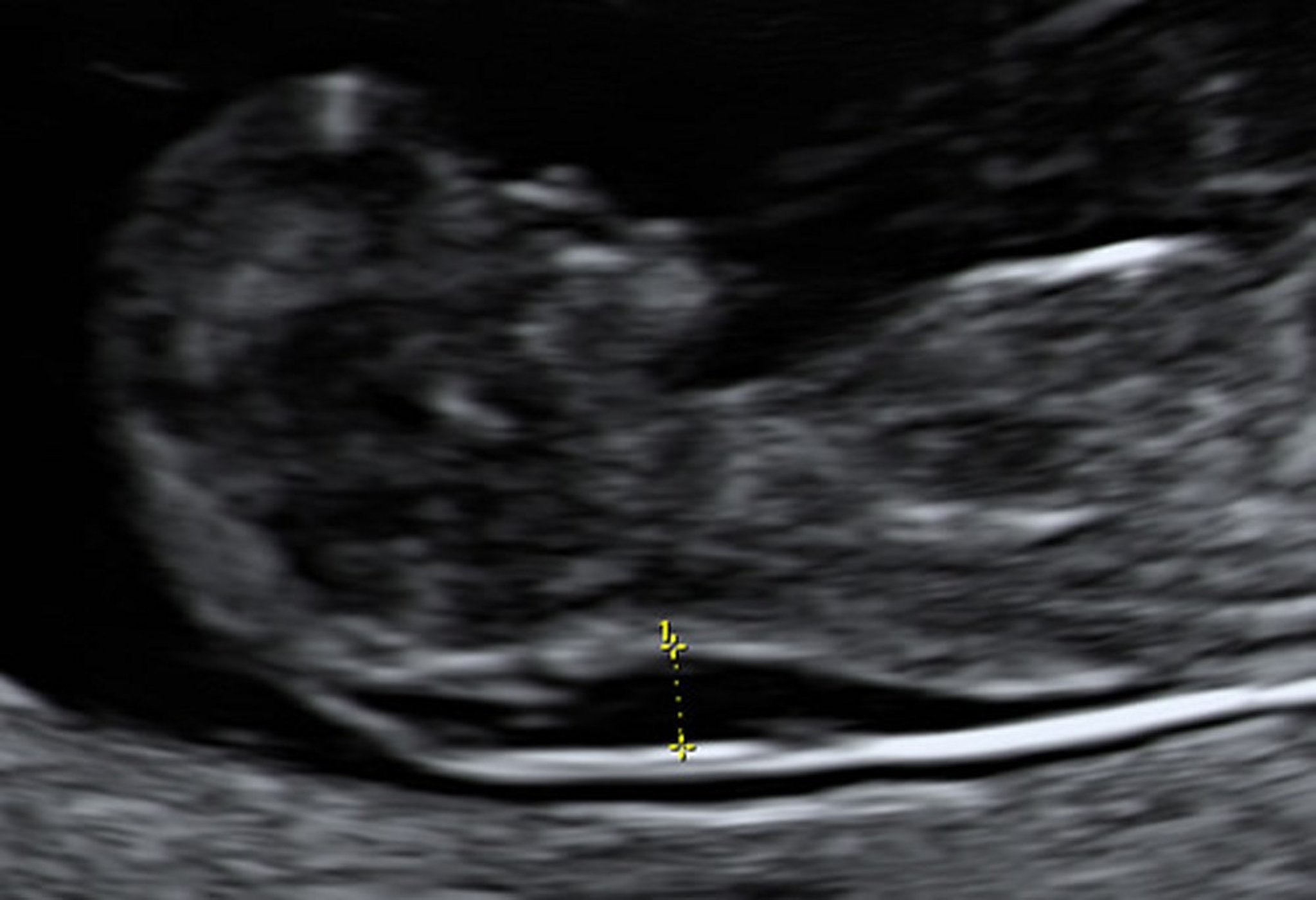Ultrasonography Showing Enlarged Nuchal Translucency in a Fetus at 10 Weeks