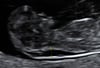 Ultraschalluntersuchung mit vergrößerter Nackentransparenz bei einem Fetus in der 10. Woche