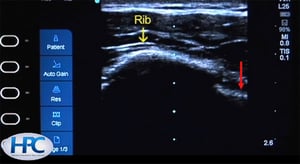 Aspecto ecográfico de las costillas y la línea pleural