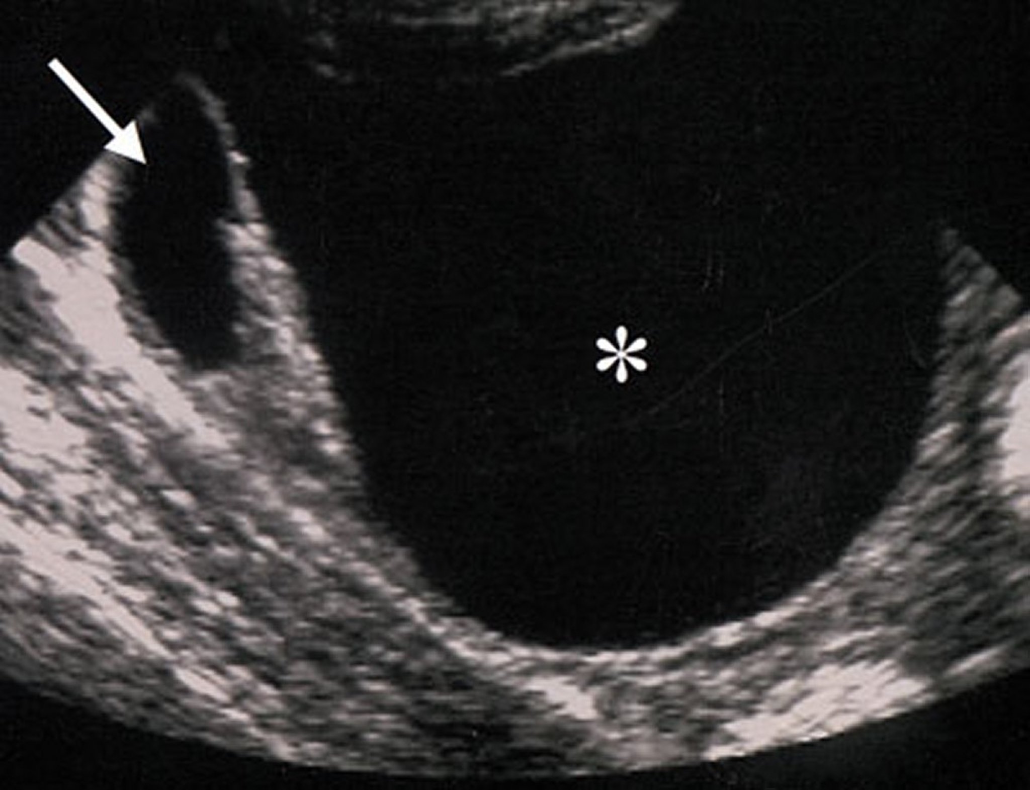Ultrasound of a Benign Ovarian Mass