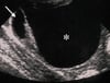 Ultrasonografia de uma massa ovariana benigna