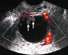 Ultrasound of a Malignant Ovarian Mass