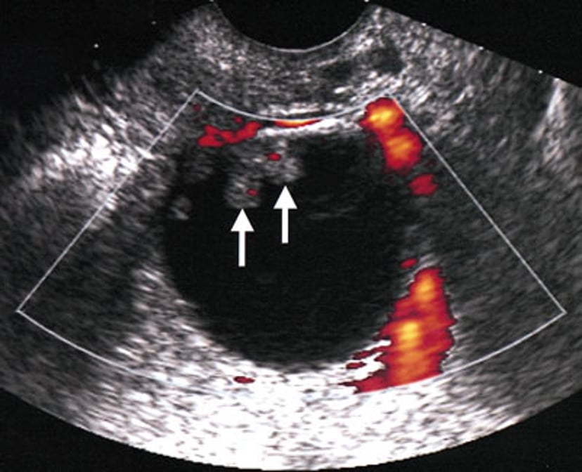 悪性卵巣腫瘤の超音波所見