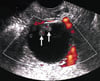 Ultrasonografia de uma massa ovariana maligna