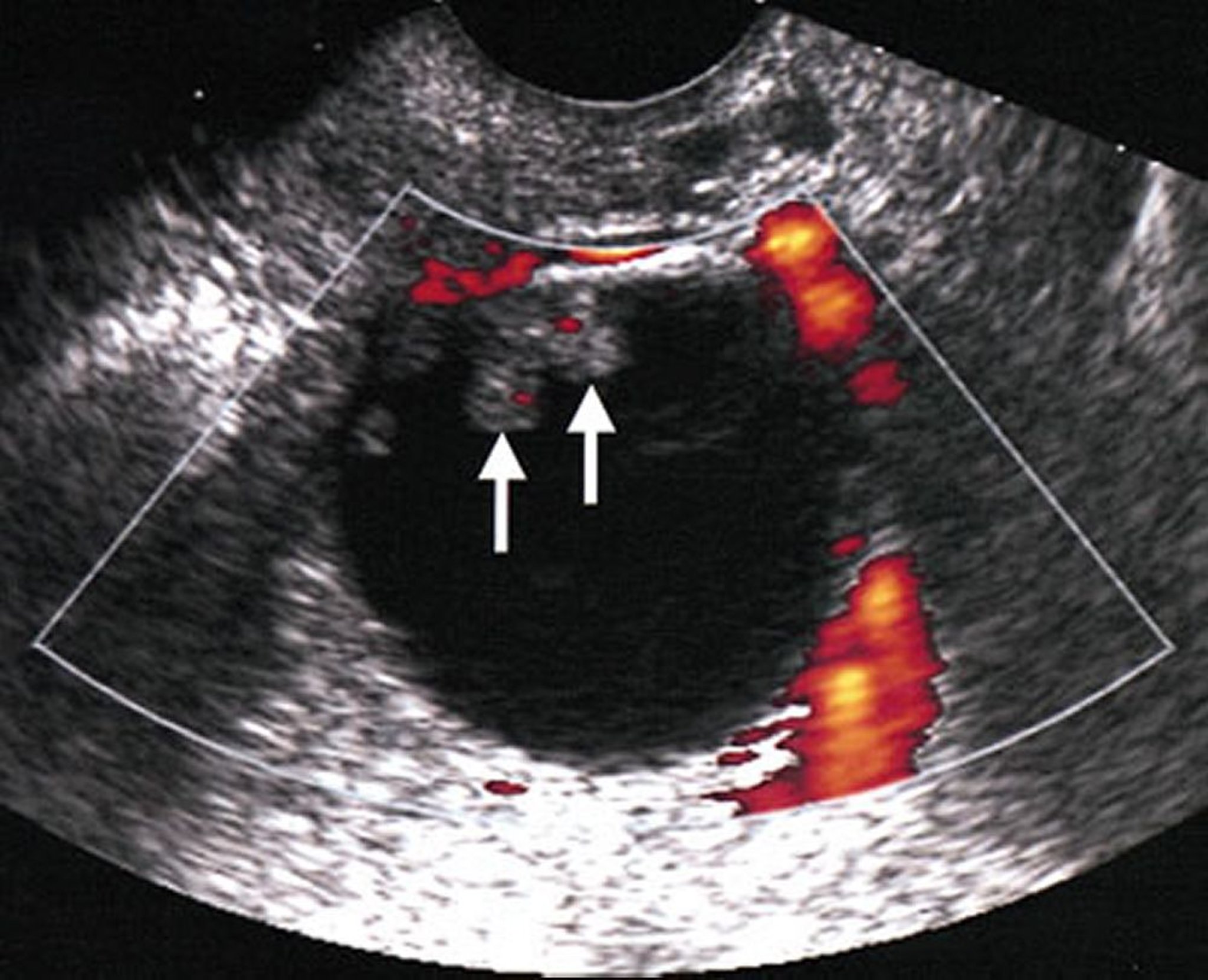 Ultrasonografia de uma massa ovariana maligna