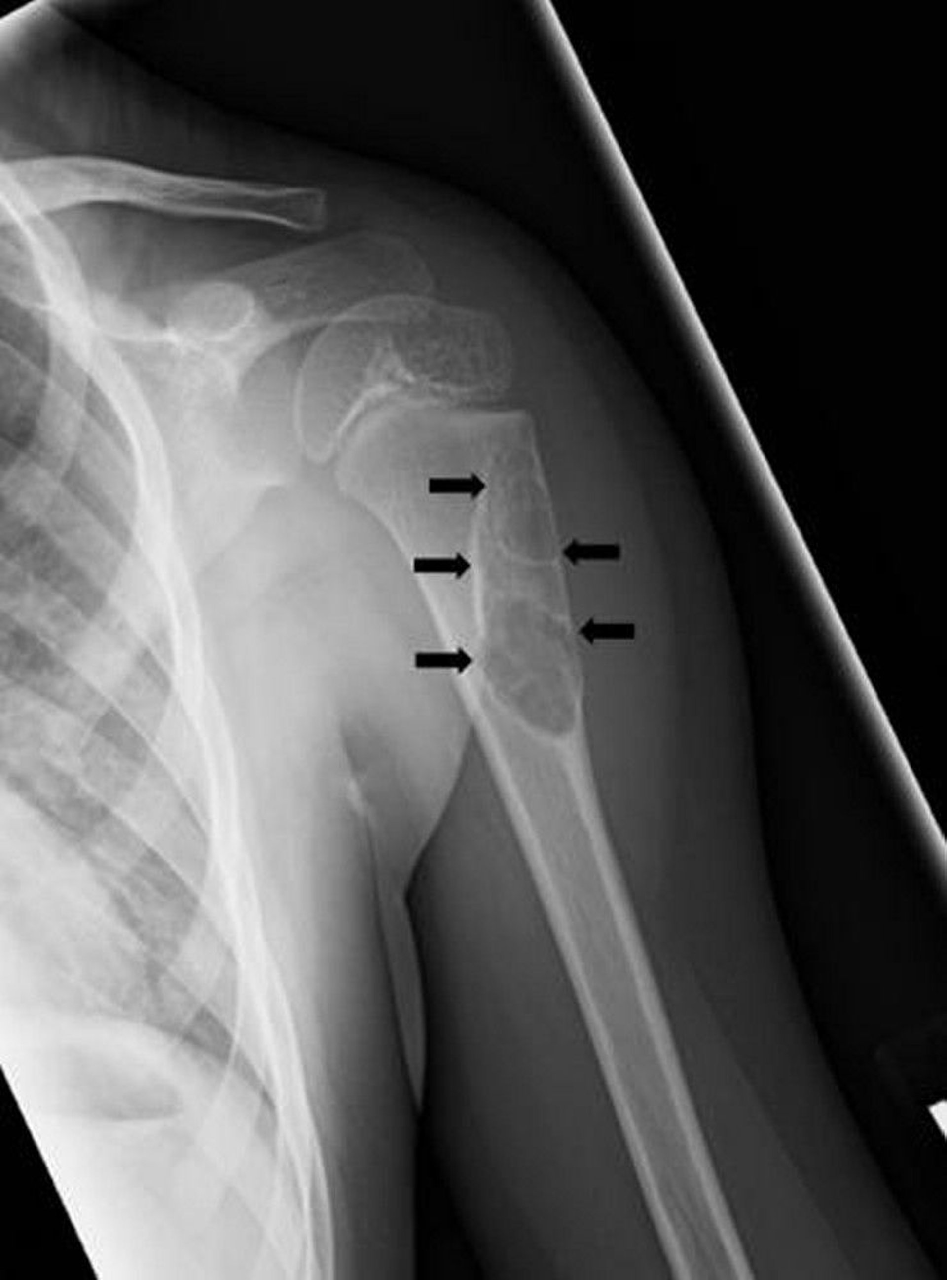 Unicameral Bone Cyst