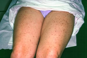 Urticaria pigmentosa (Piernas)