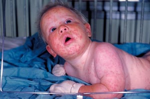 Vaccinia generalizada