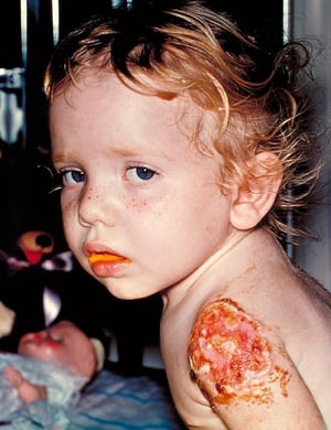 Vaccinia progressiva (envolvimento dos tecidos profundos)