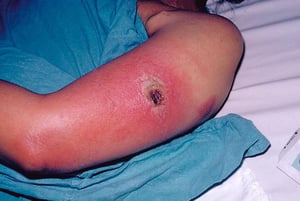 Vacínia progressiva (envolvimento da pele descrito como Vaccinia Necrosum)
