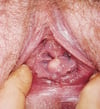 Quiste de inclusión vaginal