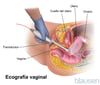 Ecografía transvaginal