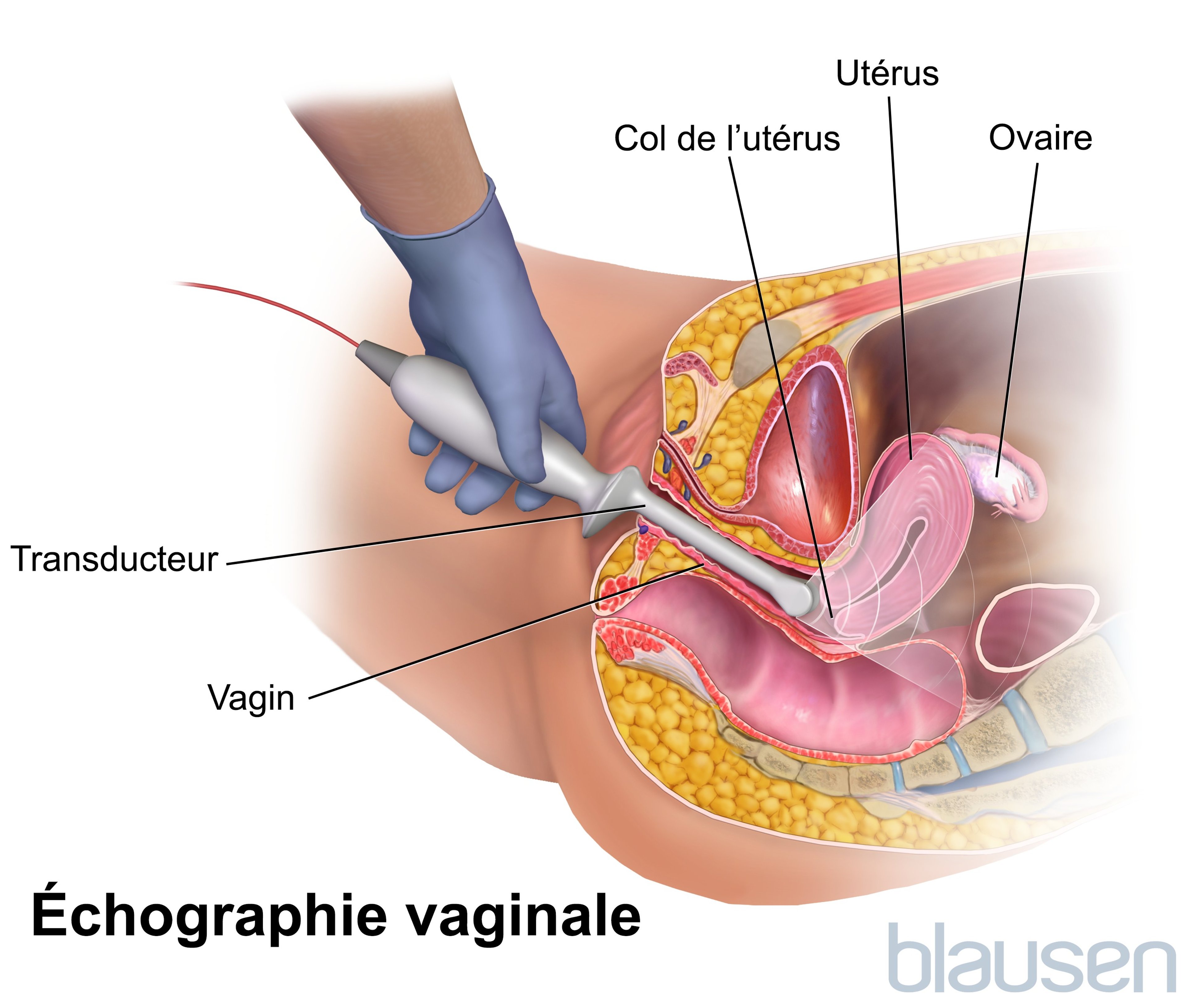 Échographie transvaginale