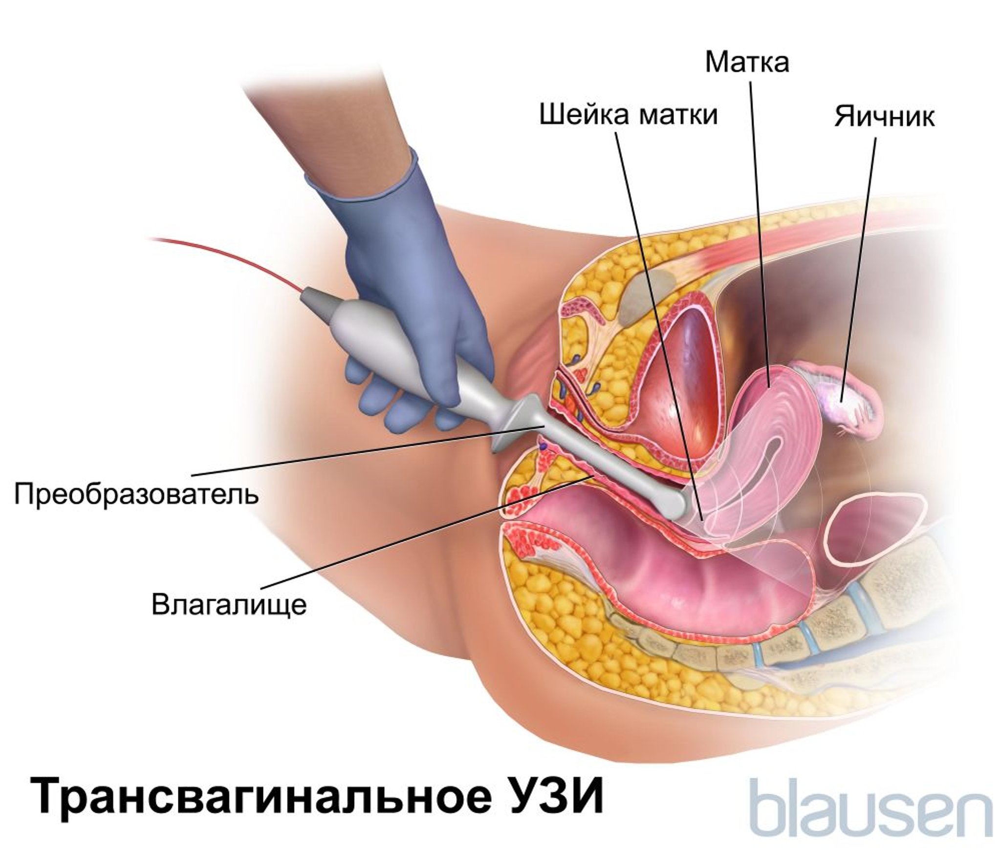 Трансвагинальная Ультрасонография