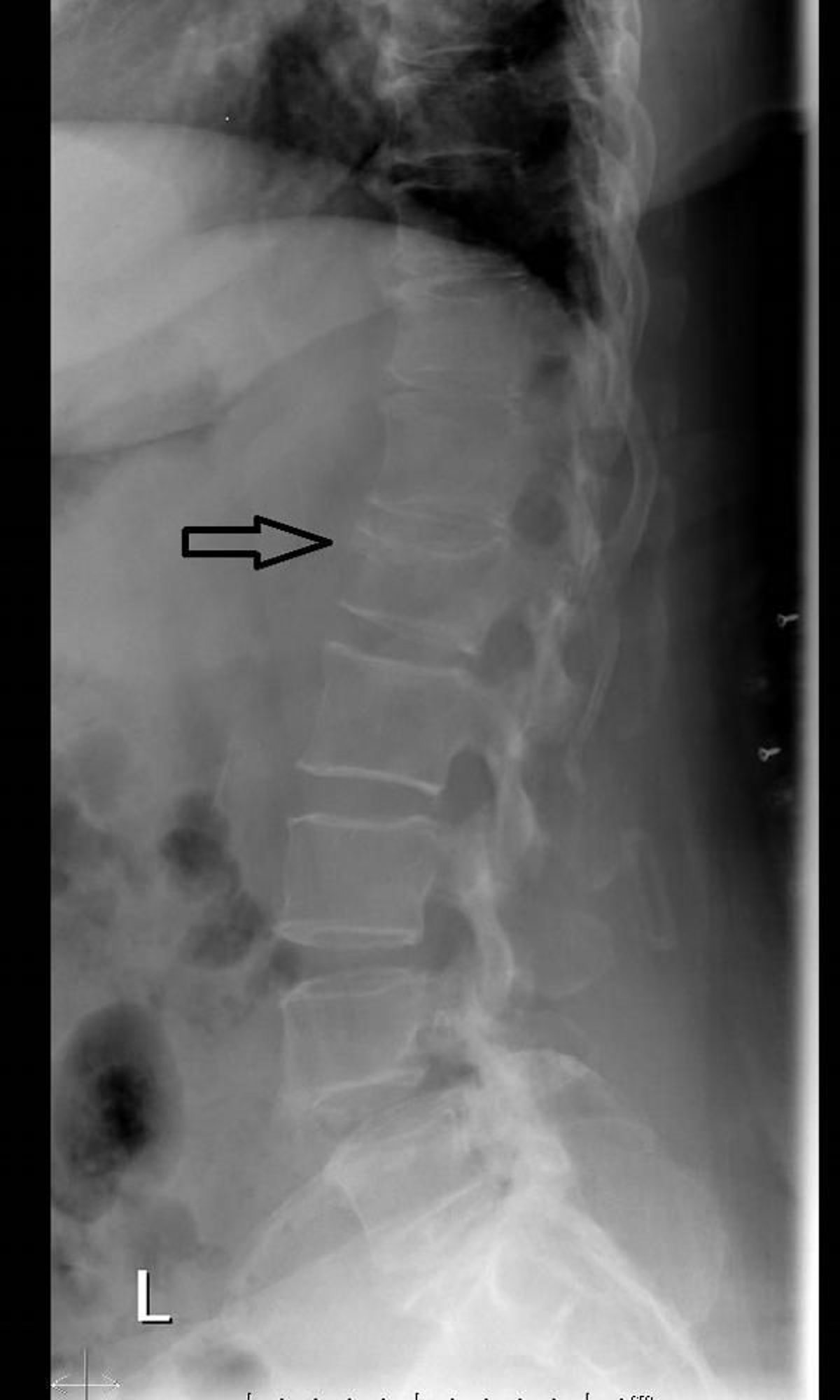 Fracture par compression vertébrale (radiographie)