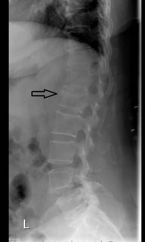 脊椎圧迫骨折（X線）