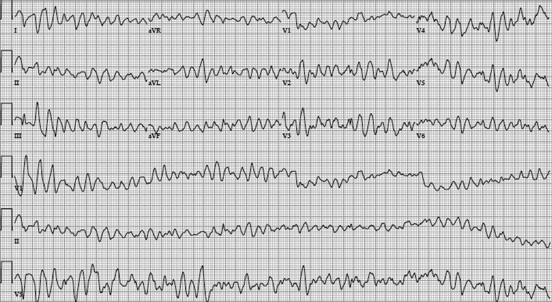 Fibrilación ventricular (ECG)