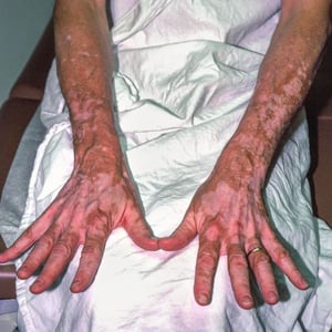 Vitiligo (manos y brazos)