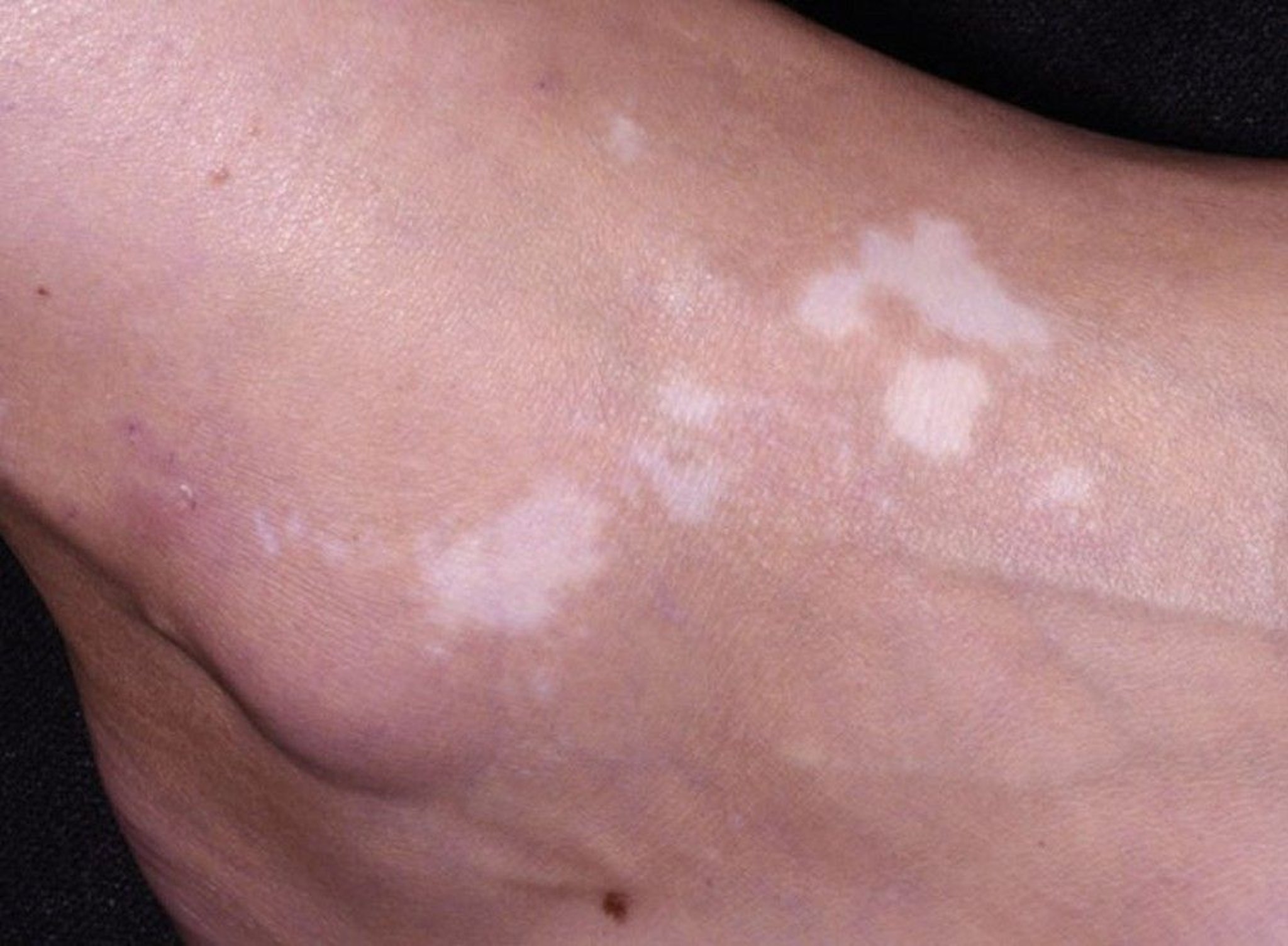 Vitiligo on the Foot