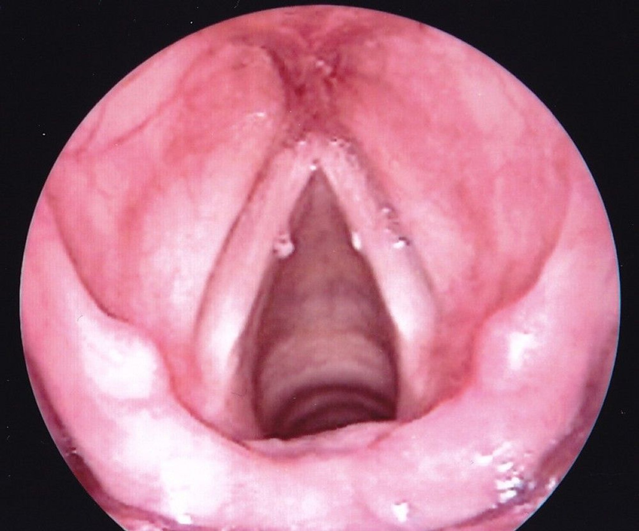 Vocal Cord Nodules